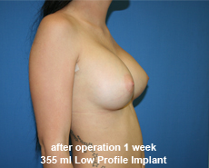 plastic-surgery-breast-augmentation